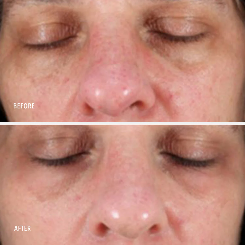 Collagen reactivate pm before - after 3
